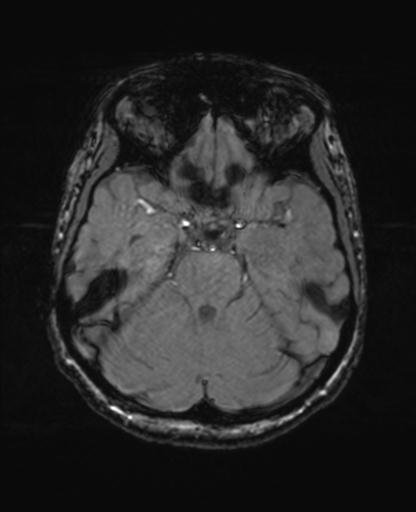 Autoimmune limbic encephalitis (Radiopaedia 30363-31005 SWI - magnitude 25).jpg