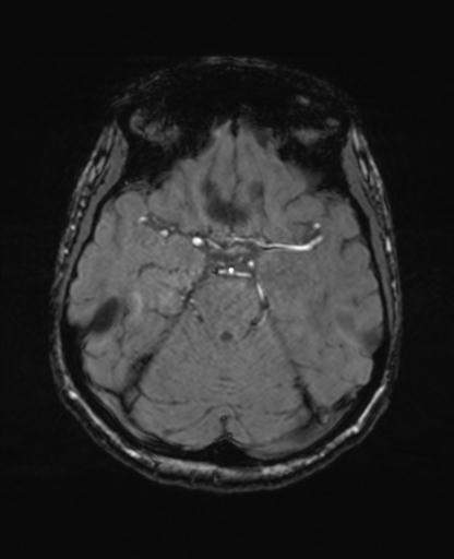 Autoimmune limbic encephalitis (Radiopaedia 30363-31005 SWI - magnitude 27).jpg