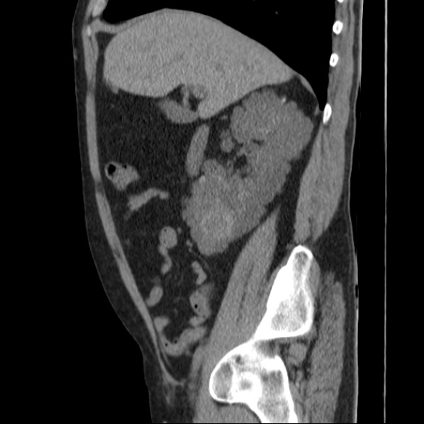 Autosomal dominant polycystic kidney disease (Radiopaedia 36539-38101 D 29).jpg