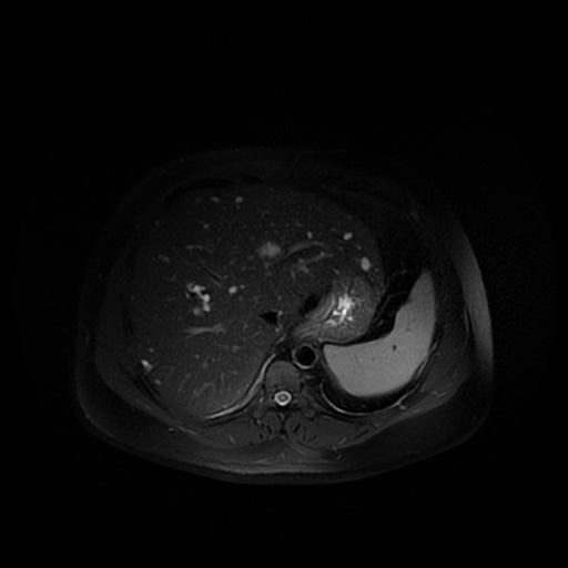 File:Autosomal dominant polycystic kidney disease (Radiopaedia 50259-55611 Axial T2 fat sat 9).jpg