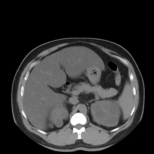 Autosomal dominant polycystic kidney disease (Radiopaedia 50259-55612 Axial non-contrast 29).jpg