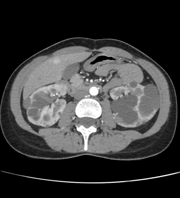 Autosomal dominant polycystic kidney disease - early onset (Radiopaedia 40734-43387 B 31).jpg