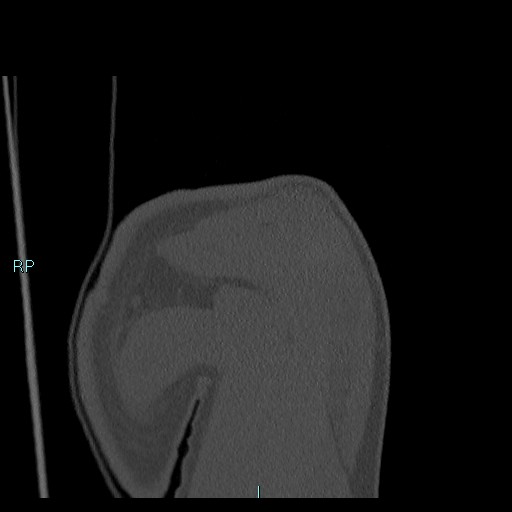 Avascular necrosis after fracture dislocations of the proximal humerus (Radiopaedia 88078-104655 Coronal bone window 38).jpg