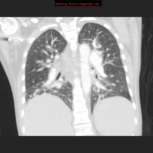 File:Avascular necrosis in sickle cell disease (Radiopaedia 17448-17152 B 81).jpg