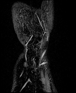 Avascular necrosis of the capitate (Radiopaedia 88317-104948 Coronal T1 vibe 95).jpg