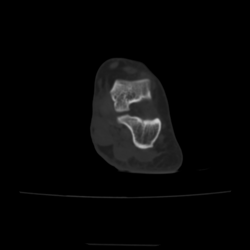 Avulsion fracture of the dorsal cuboid bone (Radiopaedia 51586-57377 Axial bone window 42).jpg