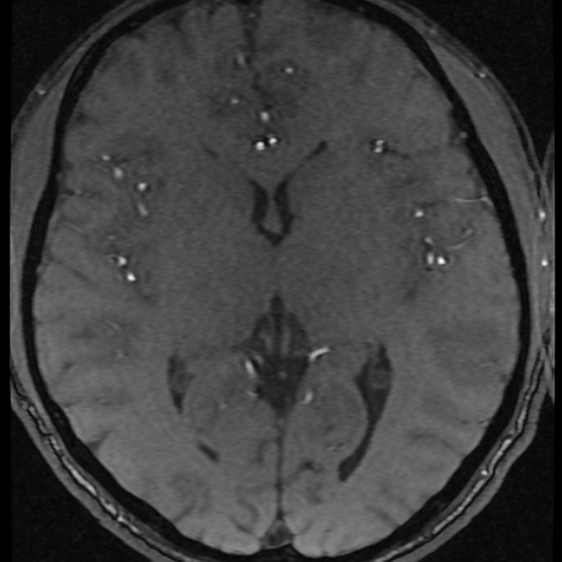 Azygos anterior cerebral artery (Radiopaedia 17059-16756 Axial MRA 12).jpg