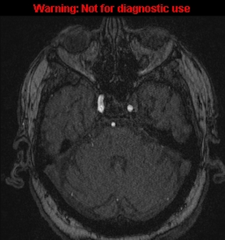 Azygos anterior cerebral artery (Radiopaedia 59325-66677 Axial MRA 43).jpg