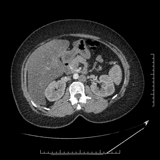 File:Azygos continuation of the IVC (Radiopaedia 40416-42965 A 31).jpg