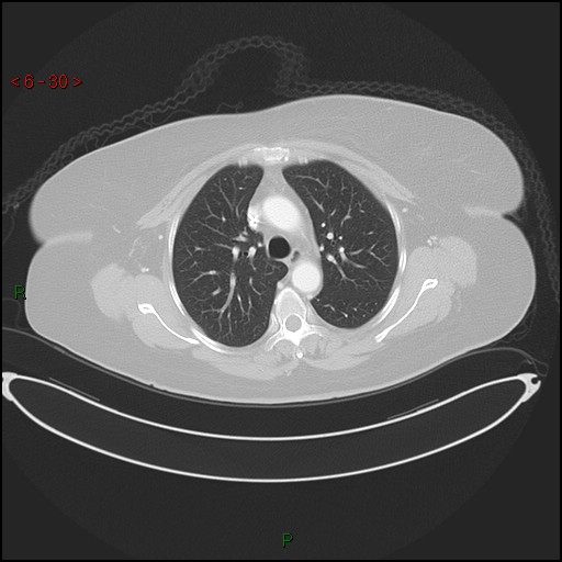 Azygos fissure and lobe (Radiopaedia 47620-52278 Axial lung window 30).jpg