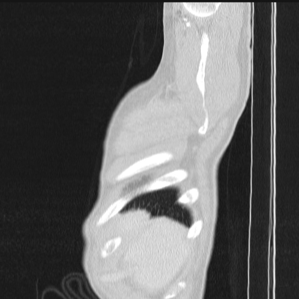 Azygos lobe (Radiopaedia 38259-40275 lung window 9).jpg