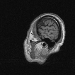 File:Balo concentric sclerosis (Radiopaedia 50458-55940 Sagittal T1 139).jpg