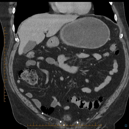 File:Bariatric balloon causing gastric outlet obstruction (Radiopaedia 54449-60672 B 20).jpg
