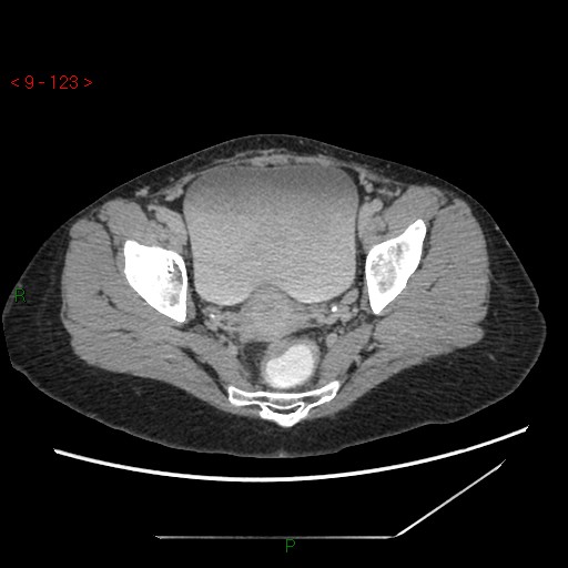 File:Bartholin gland cyst (Radiopaedia 54904-61181 Axial C+ delayed 31).jpg