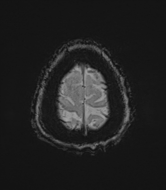 Basal ganglia metastasis (Radiopaedia 78928-91828 Axial SWI 82).png