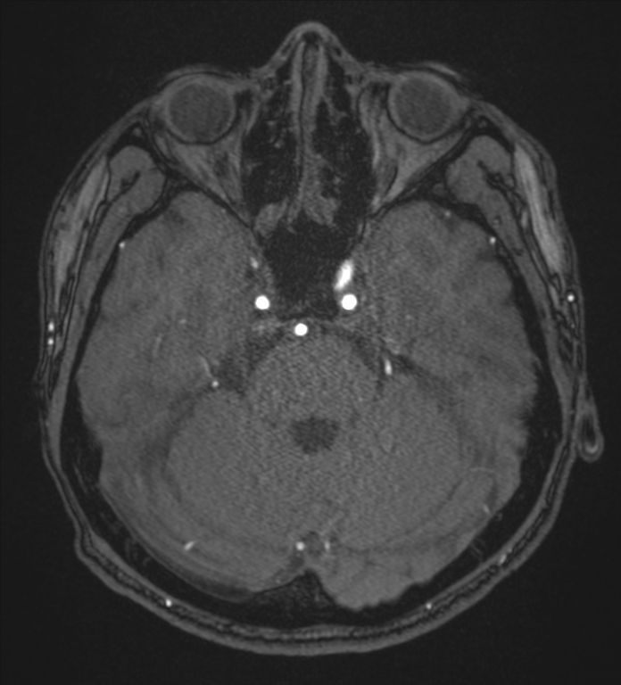 Basal ganglia subacute infarct (Radiopaedia 80201-93521 Axial MRA 29).png