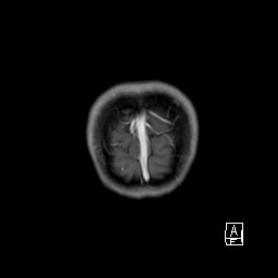 File:Base of skull rhabdomyosarcoma (Radiopaedia 32196-33142 I 70).jpg
