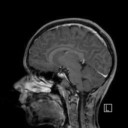 Base of skull rhabdomyosarcoma (Radiopaedia 32196-33142 J 30).jpg
