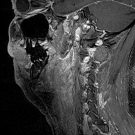 Base of tongue squamous cell carcinoma (Radiopaedia 31174-31884 F 58).jpg