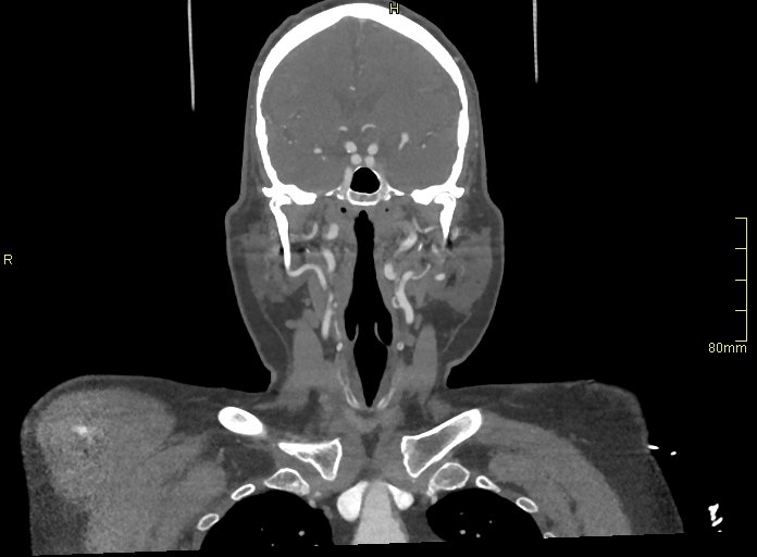 Basilar artery aneurysm (Radiopaedia 56261-62932 B 12).jpg