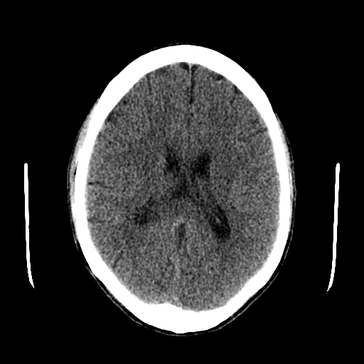 File:Basilar artery perforator aneurysm (Radiopaedia 82455-96597 Axial non-contrast 21).jpg