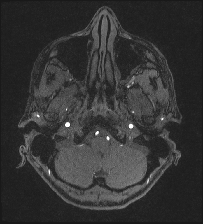 Basilar artery perforator aneurysm (Radiopaedia 82455-97733 Axial MRA 36).jpg