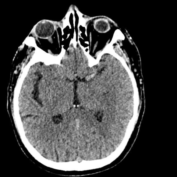 Basilar artery thrombosis (Radiopaedia 53351-59333 Axial non-contrast 62).jpg