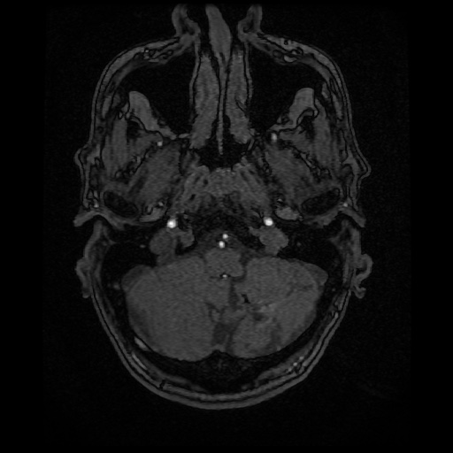 Basilar top and left middle cerebral artery aneurysm (Radiopaedia 61965-70031 Axial MRA 14).jpg