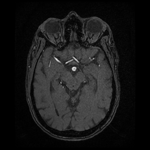 Basilar top and left middle cerebral artery aneurysm (Radiopaedia 61965-70031 Axial MRA 67).jpg