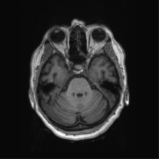 File:Behavioral variant frontotemporal dementia and late onset schizophrenia (Radiopaedia 52197-58083 Axial T1 77).png
