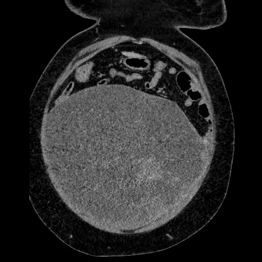 File:Benign leiomyoma with hydropic features (Radiopaedia 89250-106130 B 34).jpg