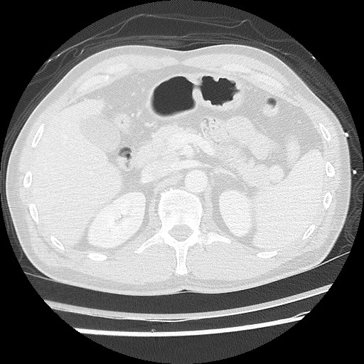 Benign post-traumatic pseudopneumoperitoneum (Radiopaedia 71199-81495 Axial lung window 74).jpg