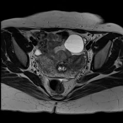 File:Bicornuate uterus (MRI) (Radiopaedia 49206-54297 Axial 24).png