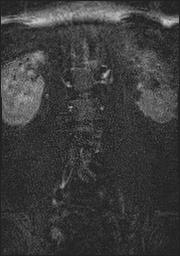 File:Bilateral L2 spondylolysis (Radiopaedia 56596-63350 Coronal STIR 2).jpg