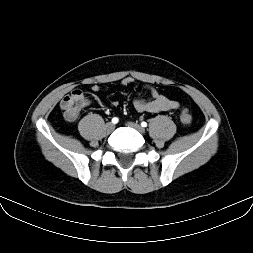 Bilateral accessory renal arteries with mild pelvi-ureteric junction (PUJ) obstruction (Radiopaedia 66357-75596 A 47).jpg