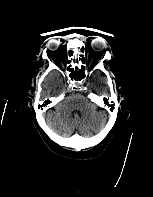 Bilateral acute middle cerebral artery territory infarcts (Radiopaedia 77319-89401 Axial non-contrast 23).jpg