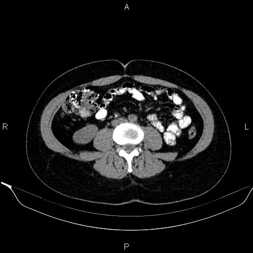 Bilateral adrenal myelolipoma (Radiopaedia 63058-71535 Axial non-contrast 102).jpg
