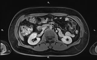 File:Bilateral adrenal myelolipoma (Radiopaedia 63058-71537 H 51).jpg