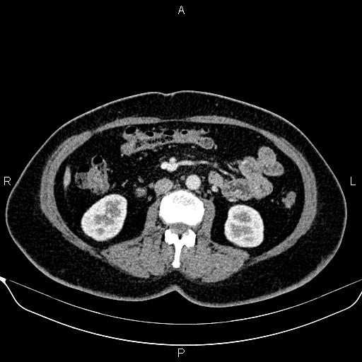 Bilateral benign adrenal adenomas (Radiopaedia 86912-103124 B 54).jpg