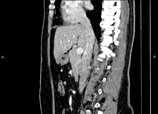 Bilateral benign adrenal adenomas (Radiopaedia 86912-103124 E 44).jpg