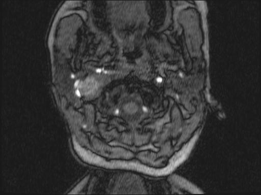 Bilateral carotid body tumors and right glomus jugulare tumor (Radiopaedia 20024-20060 Axial MRA 293).jpg