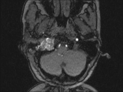Bilateral carotid body tumors and right glomus jugulare tumor (Radiopaedia 20024-20060 Axial MRA 305).jpg