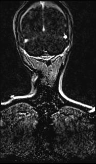 Bilateral carotid body tumors and right glomus jugulare tumor (Radiopaedia 20024-20060 MRA 144).jpg