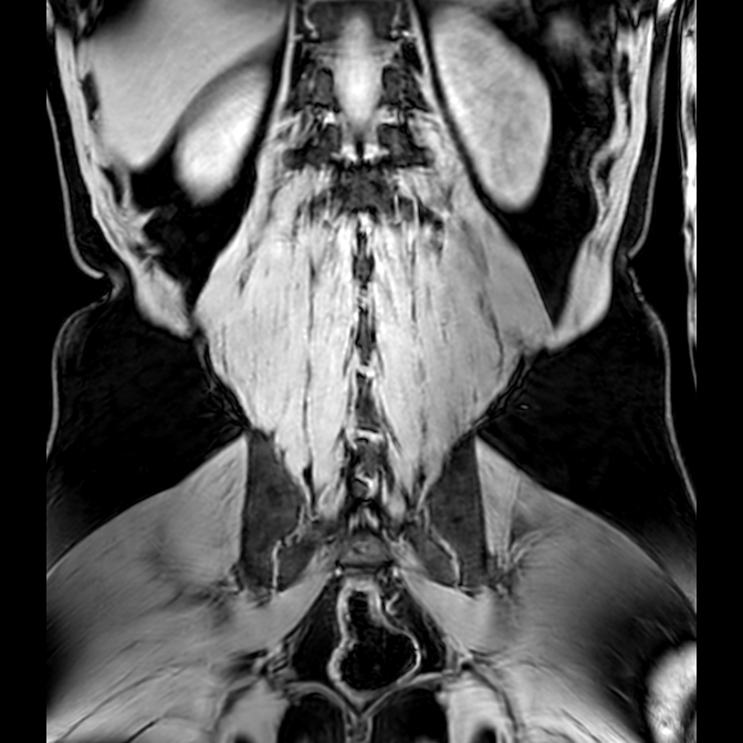 Bilateral conjoined nerve roots at different levels (Radiopaedia 73312-84063 Coronal WE 44).jpg