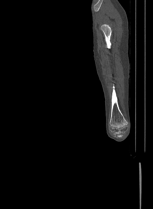 Bilateral fibular hemimelia type II (Radiopaedia 69581-79491 Sagittal bone window 69).jpg