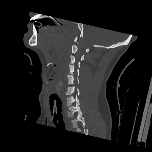 File:Bilateral locked facets (Radiopaedia 33850-35023 Sagittal bone window 38).png