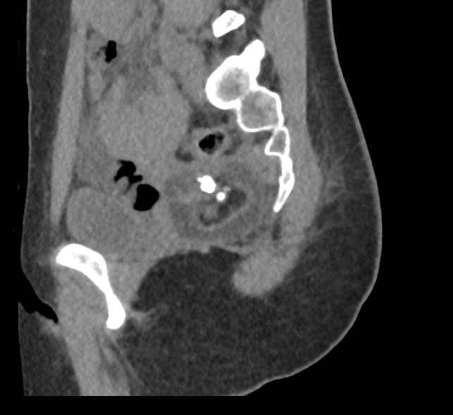Bilateral mature cystic ovarian teratoma (Radiopaedia 88821-105592 D 46).jpg