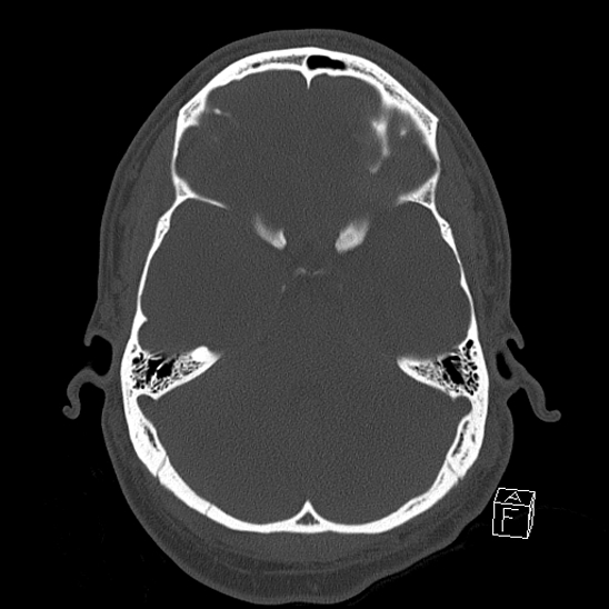 Bilateral occipital condyle fracture (type 2) (Radiopaedia 87675-104089 Axial bone window 42).jpg