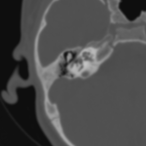 Bilateral otosclerosis (Radiopaedia 57237-64157 B 59).jpg