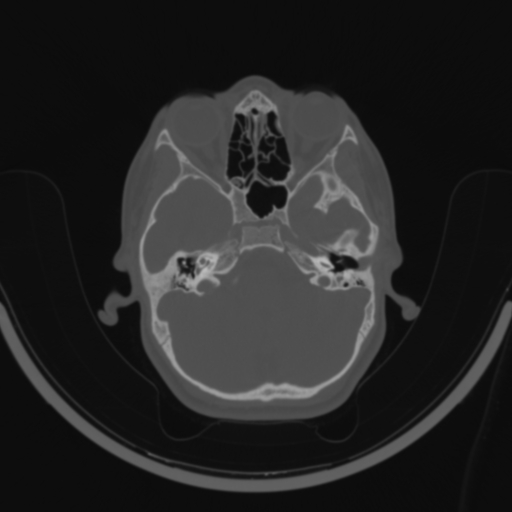 Bilateral otosclerosis (Radiopaedia 57237-64157 C 42).jpg